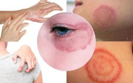 Hắc lào có thể xuất hiện ở nhiều vị trí cơ thể