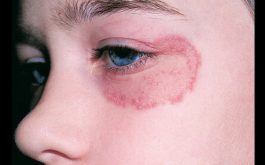 Bệnh hắc lào có nguy hiểm không phụ thuộc vào nhiều yếu tố