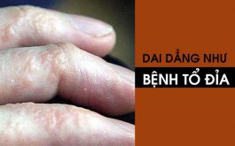 Bệnh tổ đỉa