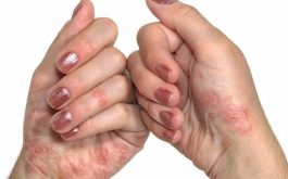 Bệnh tổ đỉa có lây không? - Đây là bệnh không lây từ người sang người
