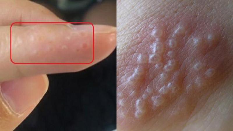 Biểu hiện của bệnh là trên da xuất hiện các mụn nước li ti