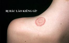 Hắc lào kiêng gì