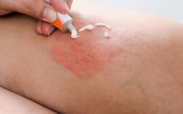 Kem trị viêm nang lông