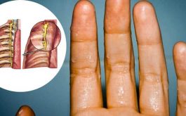 Tuyến mồ hôi phát triển mạnh cũng là một nguyên nhân gây bệnh chính