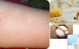 Trị viêm nang lông bằng muối