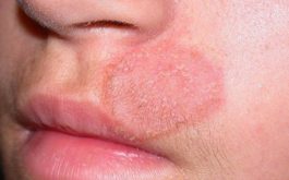 Biểu hiện của hắc lào là trên da xuất hiện những hình viền đường tròn