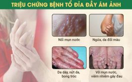 Các triệu chứng bệnh tổ đỉa thường gặp