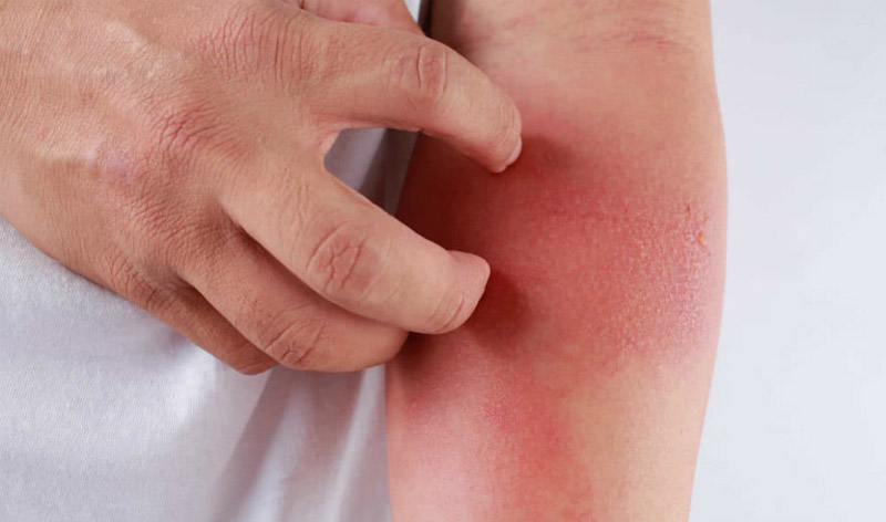 Ngứa ngáy trên da là triệu chứng điển hình của bệnh