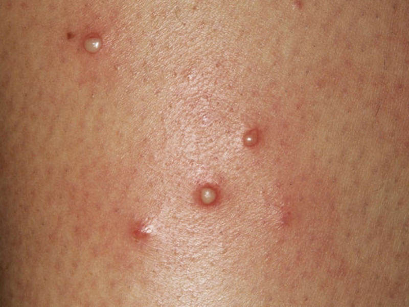 Mụn mủ là triệu chứng viêm nang lông nặng