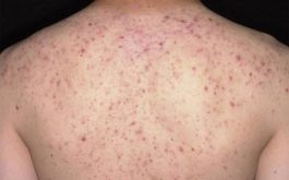 Viêm nang lông là tình trạng viêm nhiễm da phổ biến