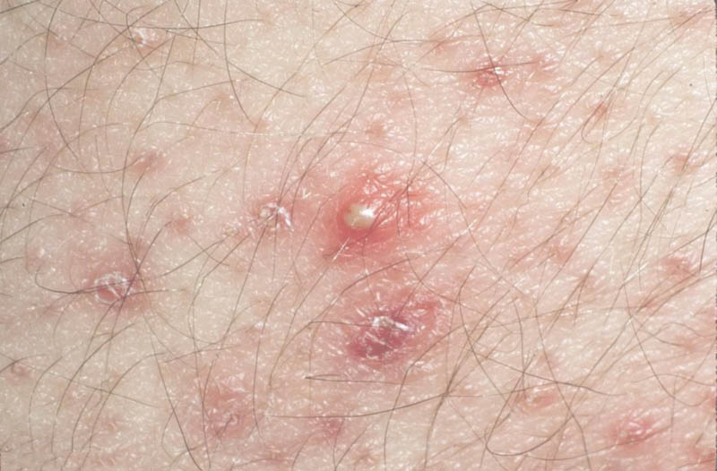Viêm nang lông vùng kín là tình trạng viêm nhiễm thường gặp