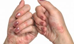 Bệnh tổ đỉa có lây không? - Đây là bệnh không lây từ người sang người