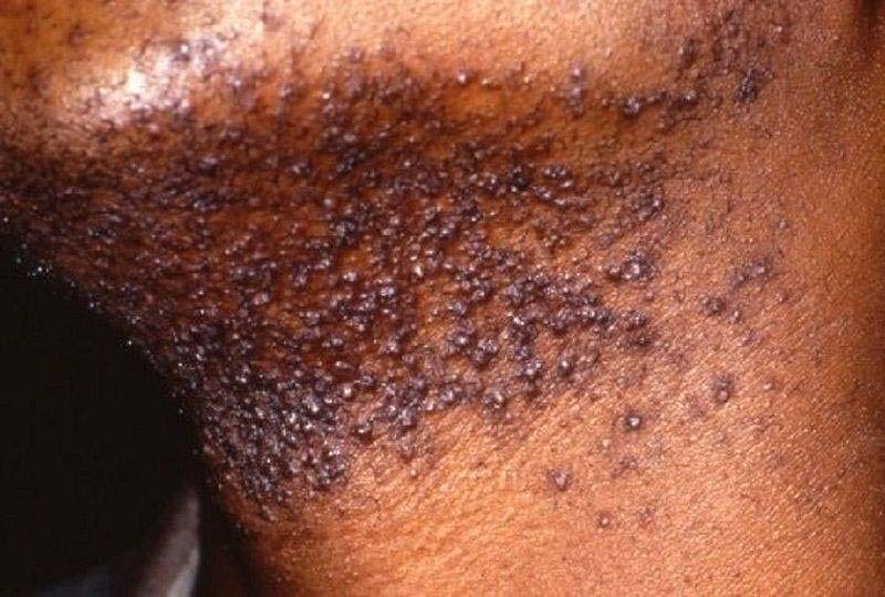 Viêm nang lông do cạo râu là tình trạng viêm nhiễm nặng