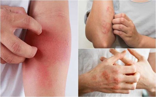 Người bệnh không nên cào gãi khi bị viêm da tiếp xúc