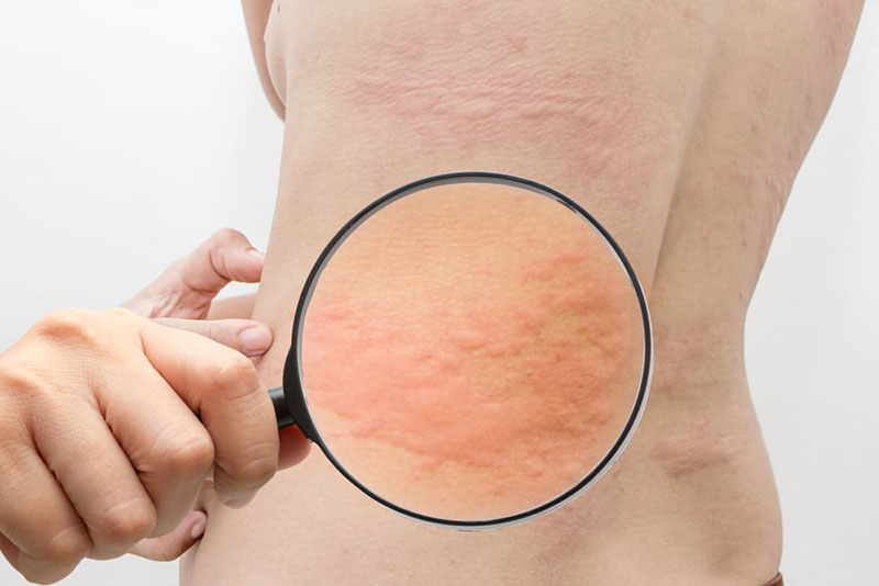 Sần phù, sưng đỏ trên da là dấu hiệu phổ biến nhất của bệnh mề đay