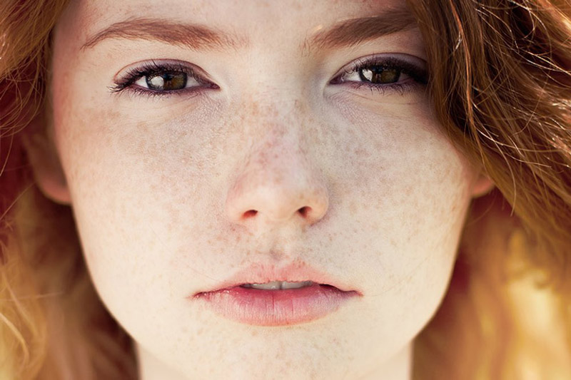 Tàn nhang thường xuất hiện nhiều ở trên da mặt