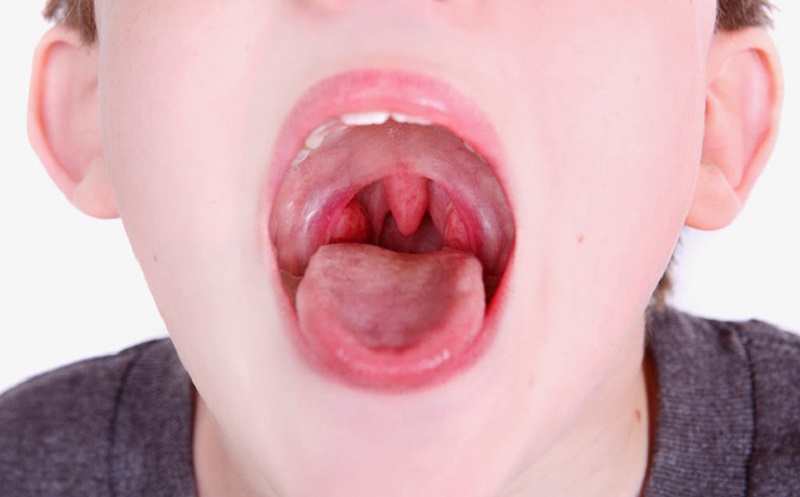 Bệnh lý viêm amidan cấp tính có thể gặp ở bất kỳ lứa tuổi nào