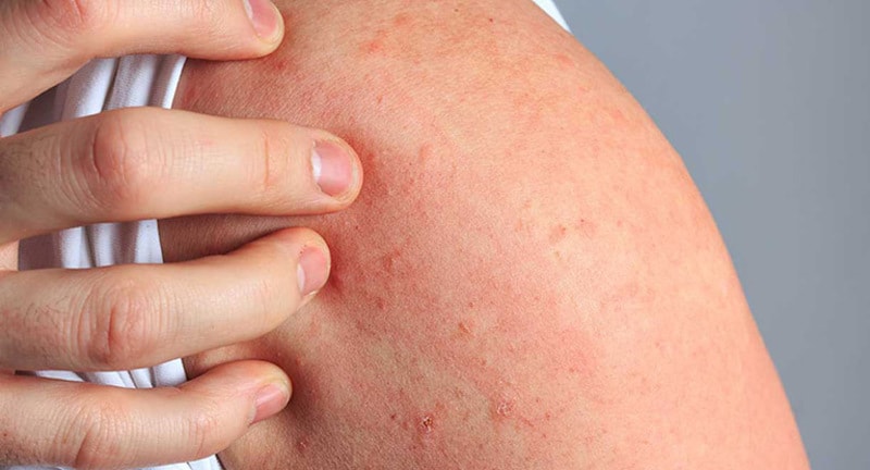 Nếu người bệnh thường xuyên cào gãi, viêm da có thể gây nhiễm trùng và để lại sẹo