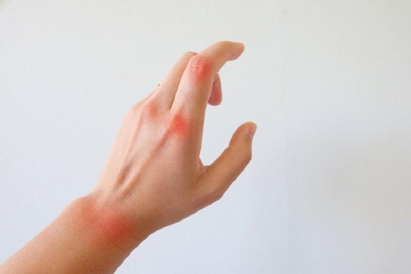 Người bệnh có triệu chứng sưng đỏ và đau đớn tại các khớp ngón tay