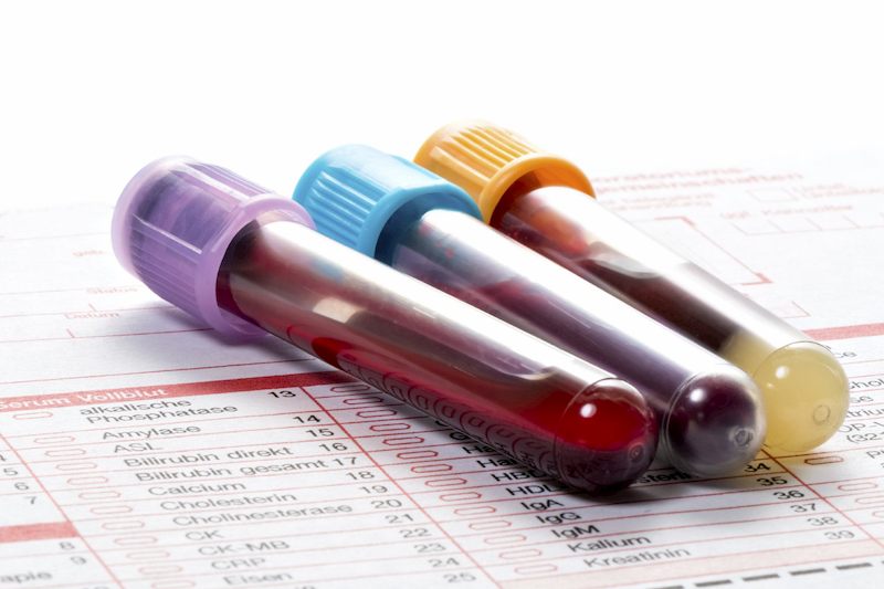 Xét nghiệm máu là cách chẩn đoán có kết quả chính xác cao