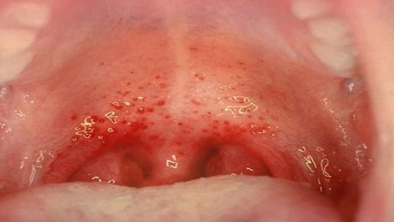 Viêm họng có nhiều thể bệnh khác nhau