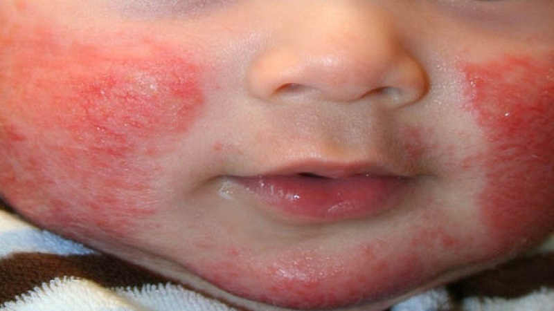 Khi bị chàm, trẻ có dấu hiệu đỏ và sưng, khô da rất khó chịu