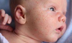Chàm sữa là loại bệnh thuộc thể bệnh chàm Eczema khởi phát ở trẻ sơ sinh và trẻ nhỏ