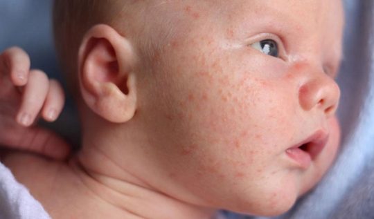 Chàm sữa là loại bệnh thuộc thể bệnh chàm Eczema khởi phát ở trẻ sơ sinh và trẻ nhỏ