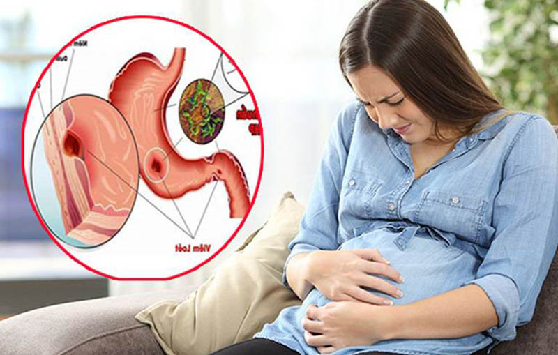 Thuốc đau dạ dày cho phụ nữ mang thai