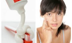 Cách trị mụn đầu đen bằng kem đánh răng sẽ ngăn ngừa sự phát triển của vi khuẩn gây mụn