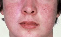Tình trạng da mặt khô ngứa mẩn đỏ có thể do nhiều nguyên nhân tác động đến