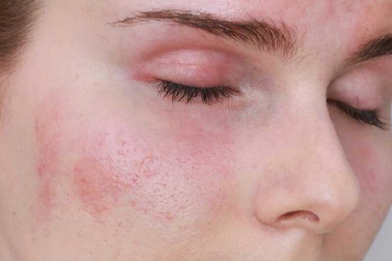 Da mặt có những mảng đỏ kèm theo cảm giác châm chích hoặc ngứa ngáy