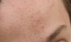Da mặt sần sùi nhiều mụn ẩn gây mất thẩm mỹ cho người bệnh