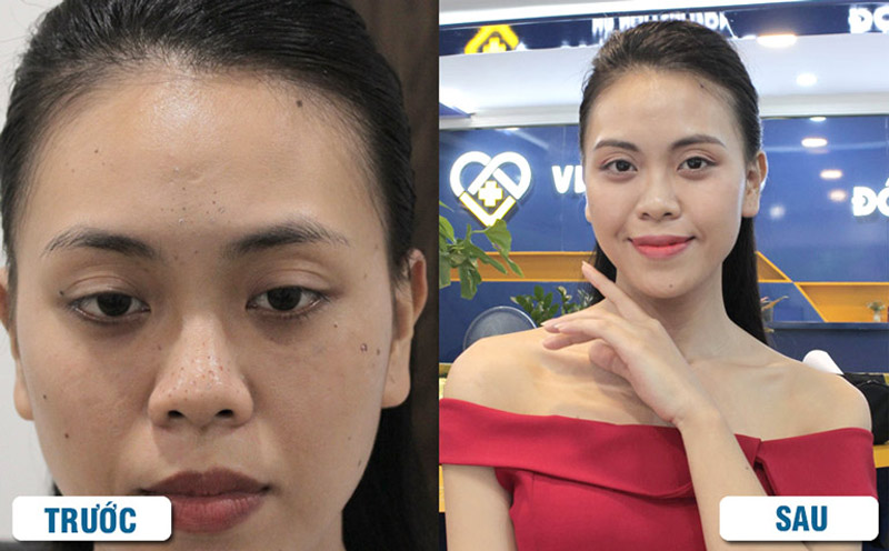 Hình ảnh của khách hàng trước và sau khi trị mụn với BSP Hoàn Nguyên