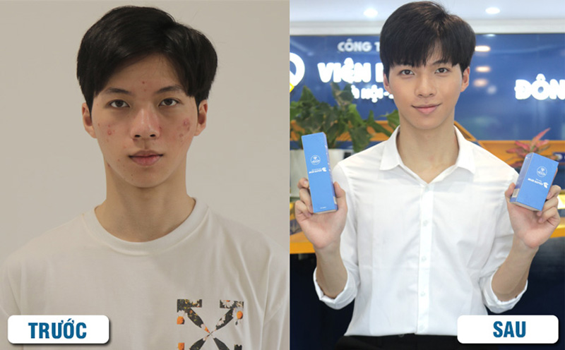 Hình ảnh của khách hàng trước và sau khi trị mụn với Bộ sản phẩm Mụn trứng cá Hoàn Nguyên 
