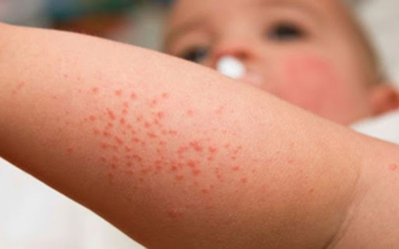 Trẻ bị nổi mẩn ngứa ngáy cha mẹ chú ý một số bệnh viêm da