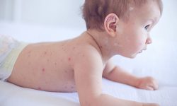 Trẻ bị nổi mẩn đỏ ngứa có thể gây ra nhiều biến chứng nguy hiểm