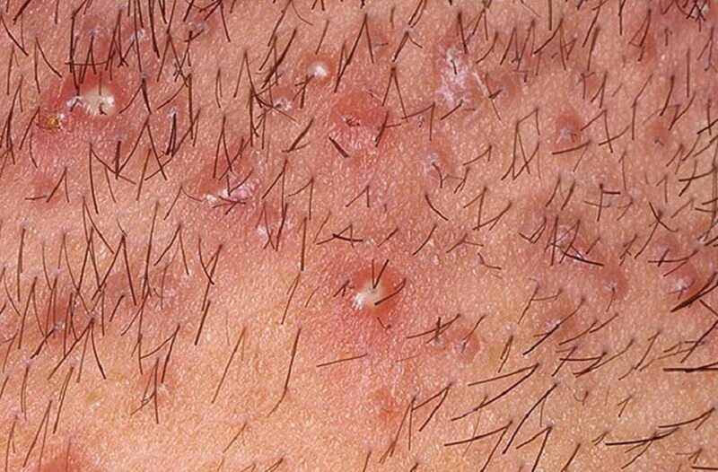Nổi mụn ở vùng kín có thể là dấu hiệu của bệnh viêm nang lông
