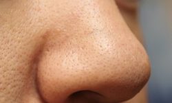 Mụn ẩn thường mọc nhiều ở mũi do mũi tiết nhiều bã nhờn