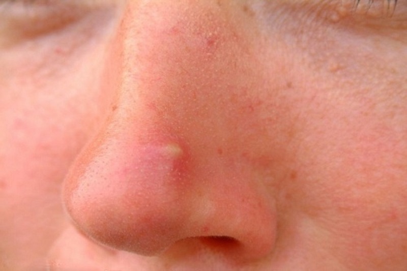 Mụn bọc ở mũi là loại mụn có kích thước lớn, gây sưng tấy, đau nhức khi chạm