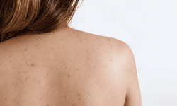 Mụn thâm ở lưng là tình trạng viêm nhiễm da thường gặp