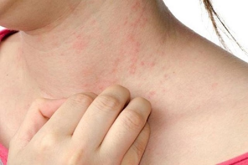 Nổi mẩn đỏ trên da thường gặp ở phụ nữ, trẻ em, người có cơ địa dị ứng