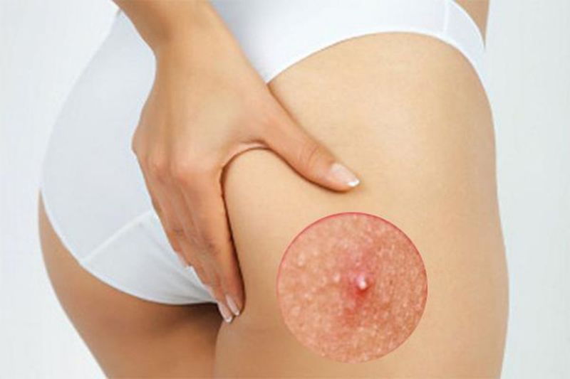 Vệ sinh không tốt là một trong những nguyên nhân hàng đầu bị nổi mẩn ngứa ở mông