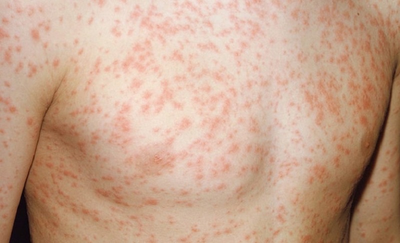 Phát ban đỏ không sốt có thể là triệu chứng của một bệnh lý nào đó