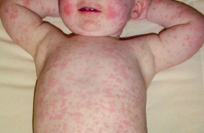 Trẻ nhỏ là đối tượng dễ bị phát ban đỏ nhất do hệ miễn dịch còn yếu
