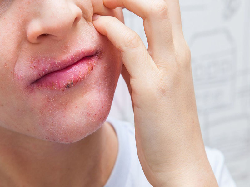 Viêm da cơ địa ở mặt là tình trạng người bệnh bị tổn thương da mãn tính ở vùng mặt