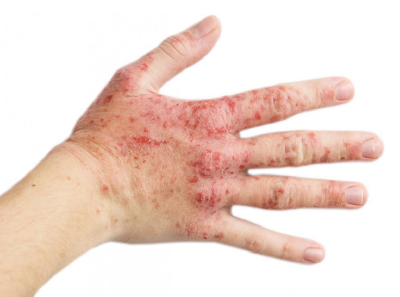 Viêm da cơ địa ở tay là một tổn thương da ở bàn tay thuộc thể mãn tính