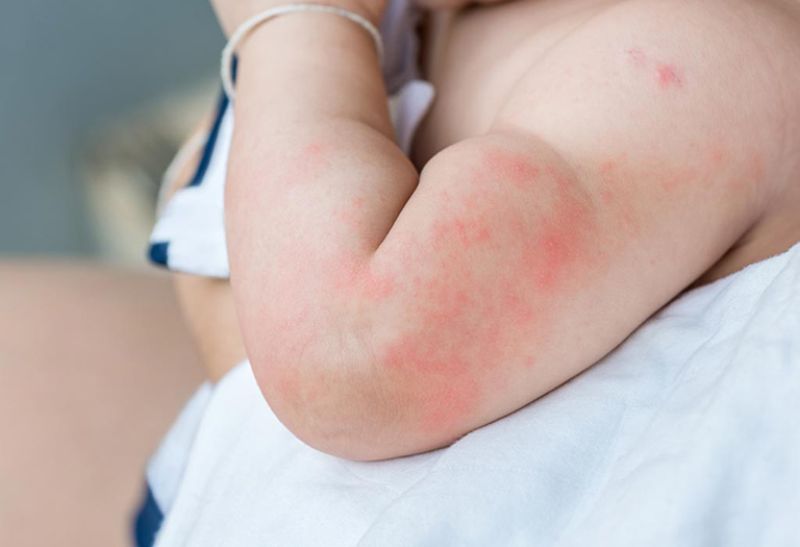Trẻ bị nổi mề đay có thể gây mẩn đỏ khắp người