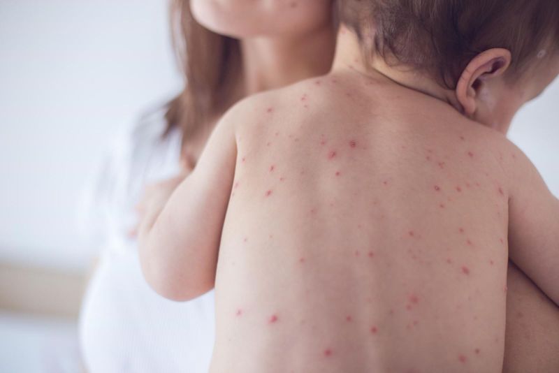 Bệnh thủy đậu khiến trẻ nổi mẩn đỏ khắp người sau sốt