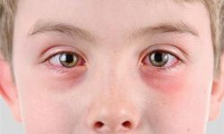 Bị nổi mẩn đỏ quanh mắt có thể là dấu hiệu của bệnh nổi mề đay